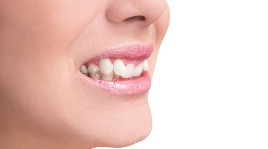 Στραβά δόντια: Επιλέγουμε τη σωστή ή την εύκολη λύση;